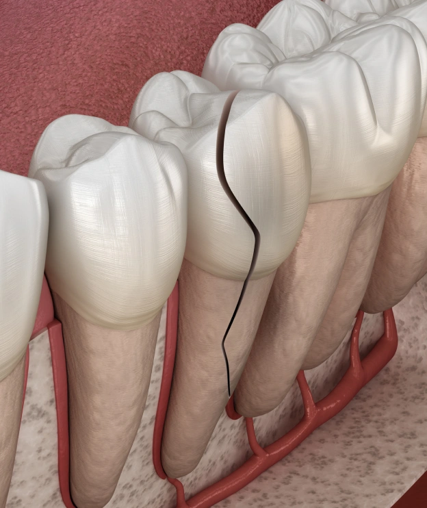 Cracked tooth diagram demonstrating fracture damage and treatment needs