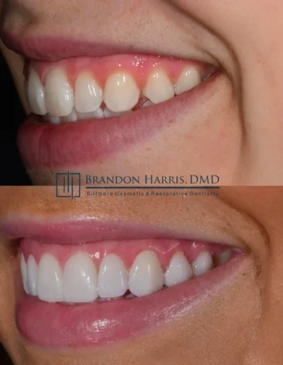Veneers correcting small teeth and improving overall smile balance
