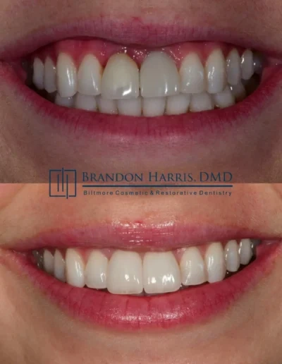 Smile makeover with veneers for whiter and straighter teeth