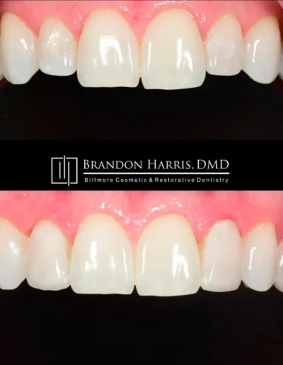 Veneers smile makeover correcting spacing and uneven tooth edges