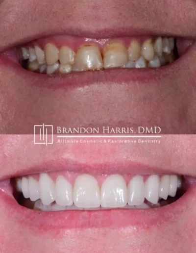 Porcelain veneers restoring damaged teeth for a complete smile makeover