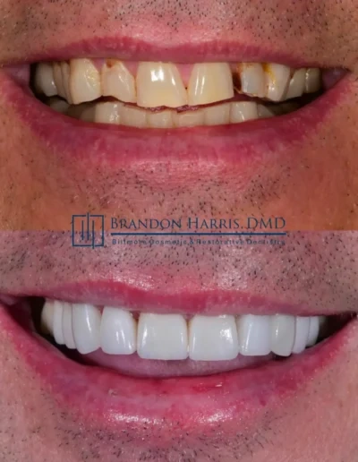 Veneers transforming severely worn and damaged teeth into a healthy smile