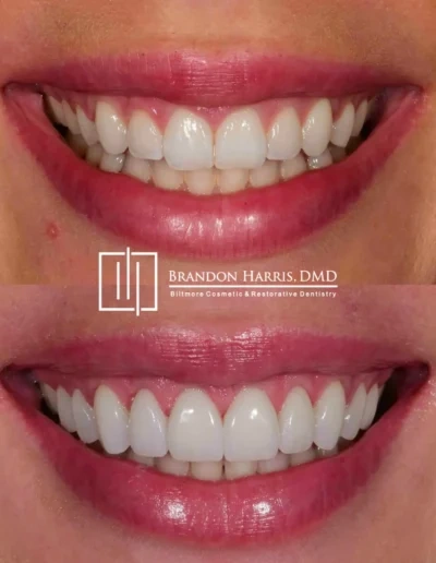 Veneers before and after correcting worn, stained, and damaged teeth