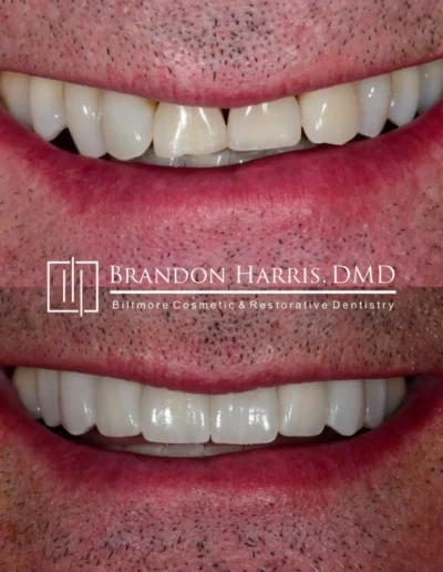 Smile makeover using custom porcelain veneers for a brighter smile