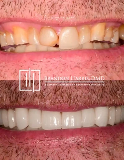Cosmetic veneers before and after showcasing natural-looking dental results