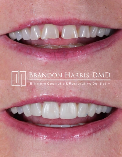 Before and after smile transformation following cosmetic dental treatment