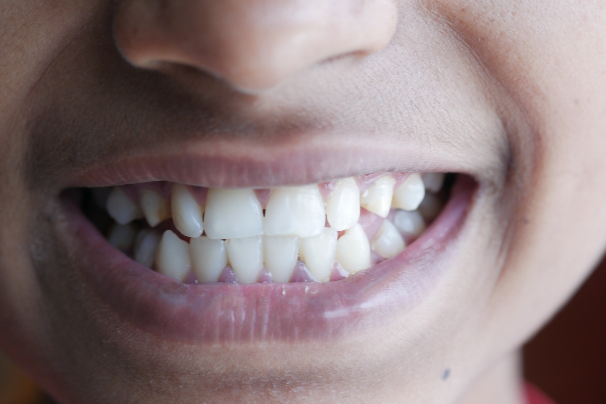 Can Invisalign Fix Black Triangles Between Teeth