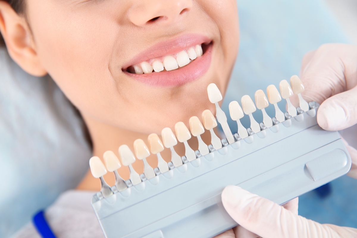 How to Pick the Right Veneer Shade for Your Skin Tone